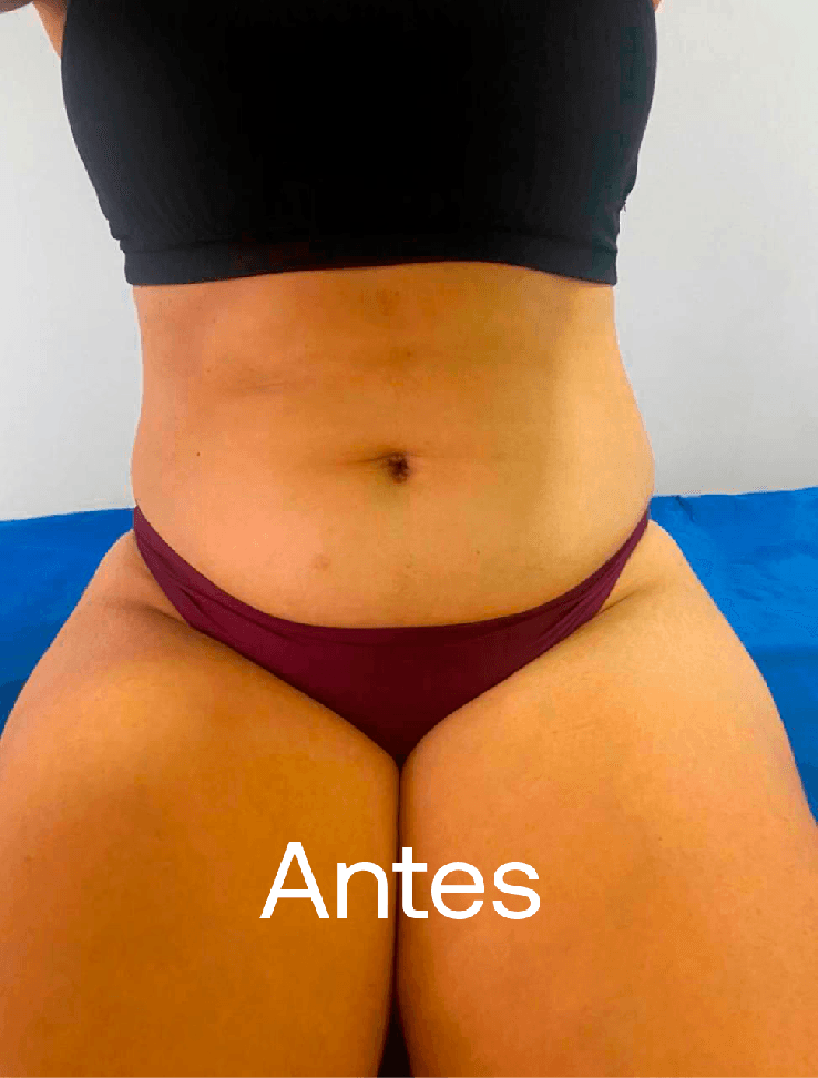 Criolipólise - Antes